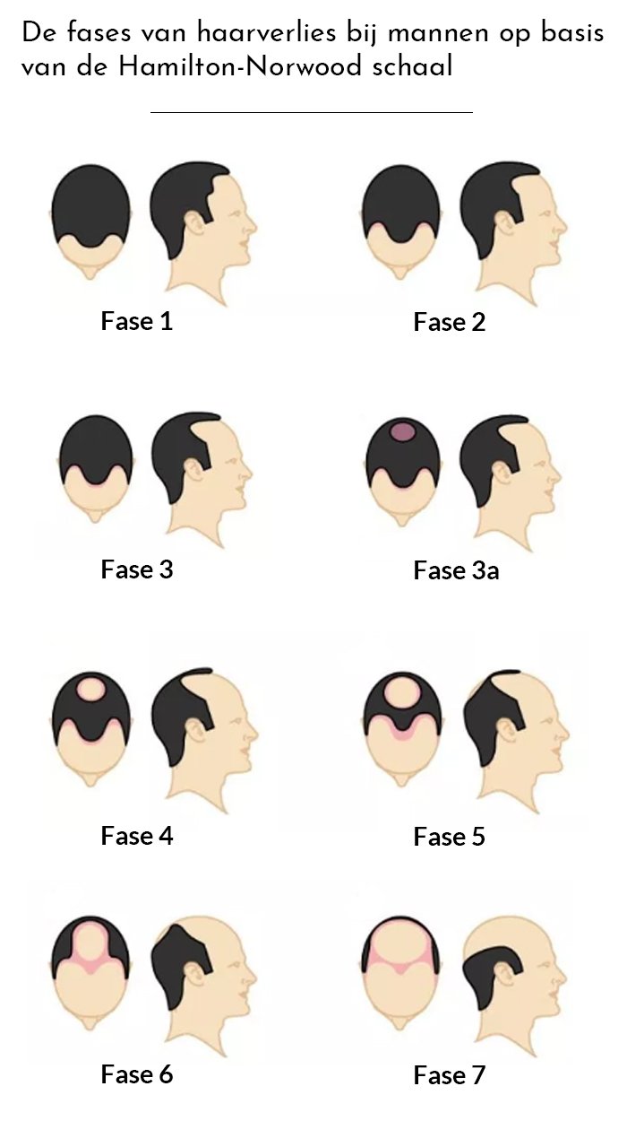 Fases van kaal worden bij mannen